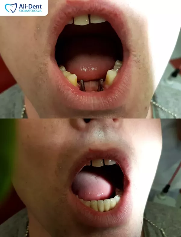 Implantologia - most porcelanowy na implantach
